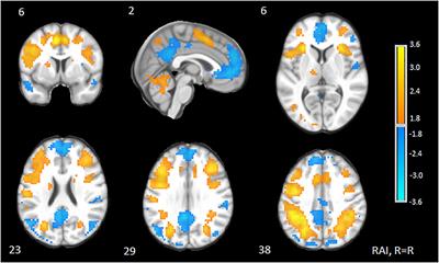 Neurocompensatory Effects of the Default Network in Older Adults